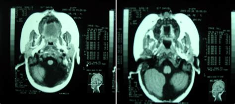 Arachnoid Cyst Of Posterior Fossa Brain Mri Cerebellar Download Scientific Diagram