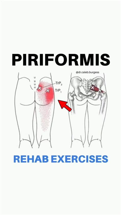 Alles Over Het Piriformis Syndroom Behandeling Artofit