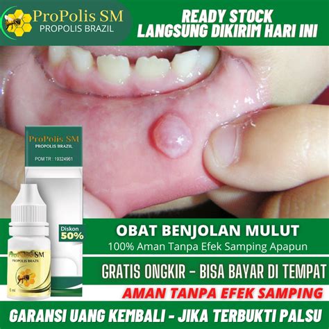 Jual Obat Penghilang Benjolan Di Lidah Mulut Bibir Obat Benjolan Di Pangkal Lidah Obat