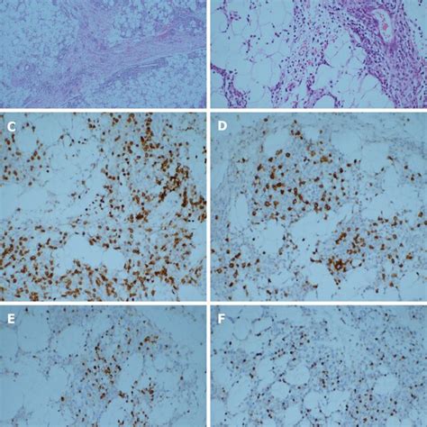 The Hematoxylin Eosin Staining Of The Resected Specimens Revealed That