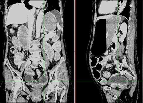 Figure 1 From An Unusual Case Of Early Stage Obturator Hernia Causing