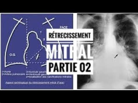 R Trecissement Mitral Partie Youtube