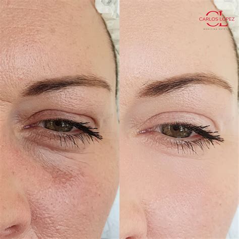 Blefaroplastia o Cirugia de párpados Master Estetic