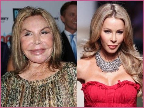 Celebrity Plastic Surgery Cosmetic Surgery Gone Wrong Is It Just Plastic Surger