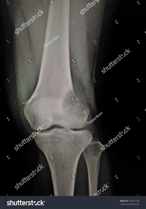 Xray Knee Joint Aplateral Geographic Osteolytic Stock Photo Edit Now