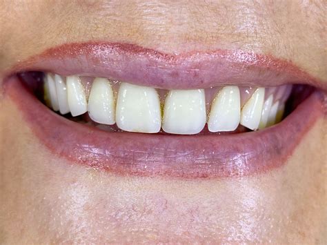 Smile Gallery Before And After Dentures In Surrey Bc