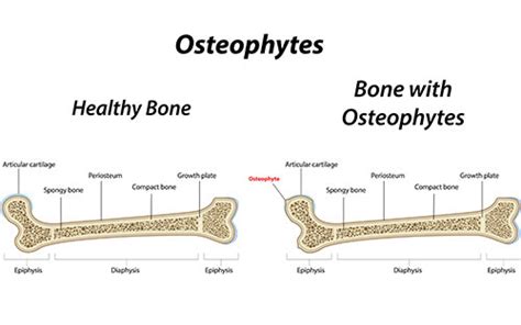 Osteophyte (Bone Spur) Causes, Symptoms, and Treatment