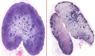 Indolent Lymphoma: What You Need to Know | Symptoms and Signs