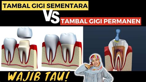 Perbedaan Tambal Gigi Sementara Dan Tambal Gigi Permanen Tahan Berapa