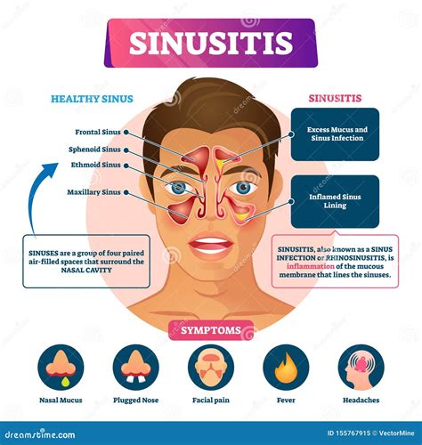 Sinusitis Stock Illustrations 1 340 Sinusitis Stock Illustrations