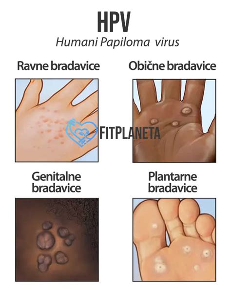 Kako Izbaciti Hpv Virus Iz Organizma