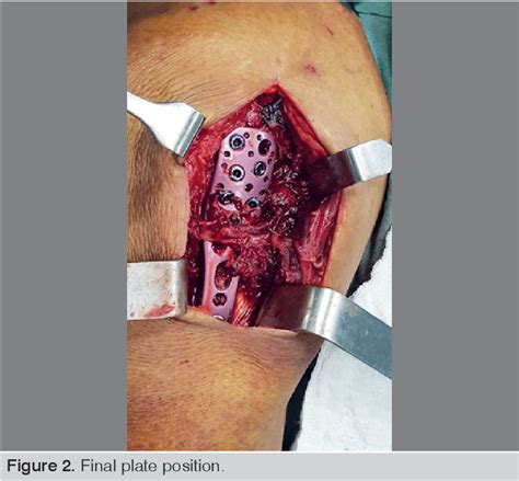 Figure 1 From Proximal Humeral Fractures Treated With Osteosynthesis