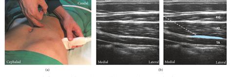 Figure 1 From Transversus Abdominis Plane Block An Updated Review Of