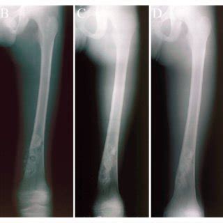 Images of an 11-yr-old male with nonossifying fibroma in the left femur ...