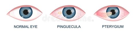 Pinguecula Human Eye Disease Stock Illustration Illustration Of