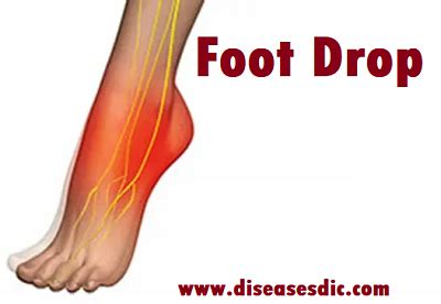 Foot Drop – Types, Causes and Treatment