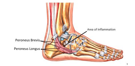 Peroneal Tendonitis Learn More About Peroneal Tendonitis