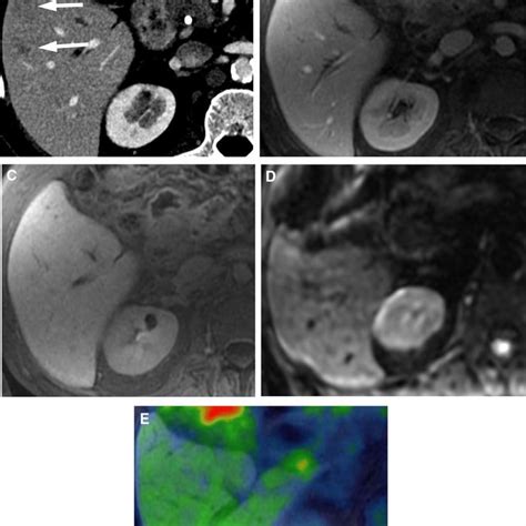 68 Year Old Man With Pancreatic Ductal Adenocarcinoma Pda Undergoing