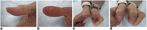 Reconstruction Of The Thumb Tip Musculoskeletal Key