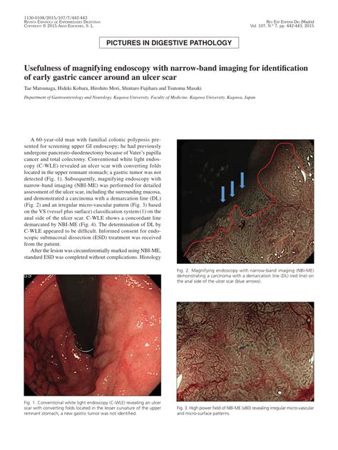 PDF Usefulness Of Magnifying Endoscopy With Narrow Band Imaging For