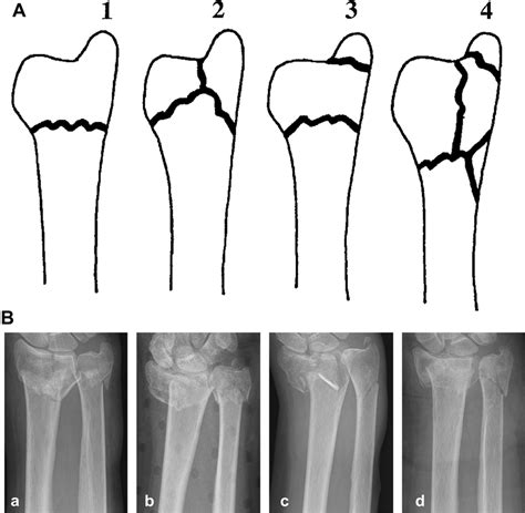 A Fracture Classification Of The Distal Ulna According To Biyani Et Al