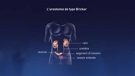 La Vessie Urologie Centre Urologie Sud Parisien