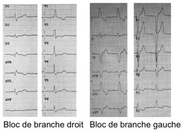 Anomalie de la repolarisation généralités uness wiki ecg