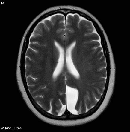 Porencephalic Cyst Mri