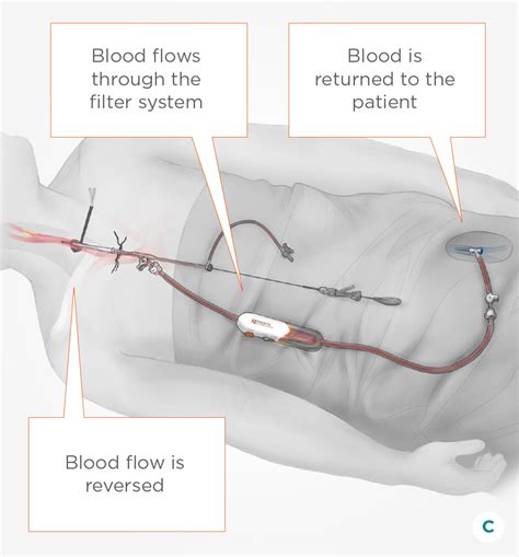 Carotid Artery Disease Treatment How TCAR Works