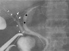 Triple Confluence Type Operative Cholangiogram Demonstrates