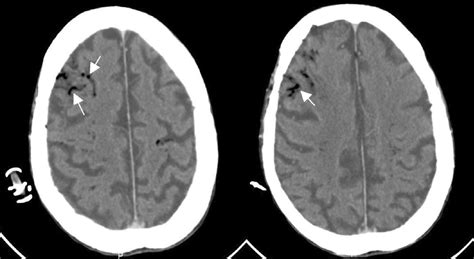 Contrast Enhanced Abdominal Computed Tomography Demonstrates Air In