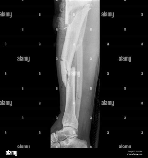 Compound Fracture X Ray