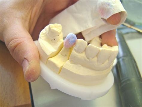 How Dental PFM Crowns are Made | Step-by-Step Photos ★ | HubPages