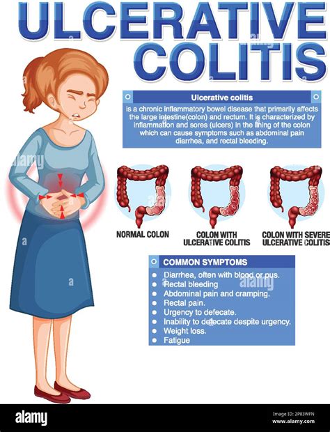 Ulcerative Colitis Symptoms Infographic Illustration Stock Vector Image