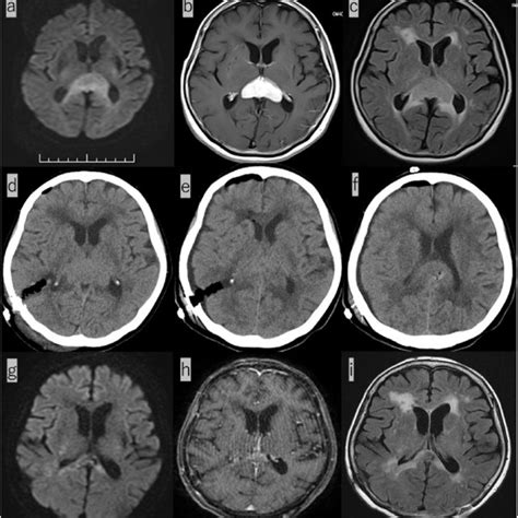 A C A Dwi B Contrast Enhanced T C Flair Initial Head Mri