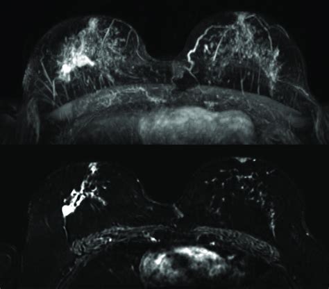 Maximum Intensity Projection Mip Top Image And Subtraction Image