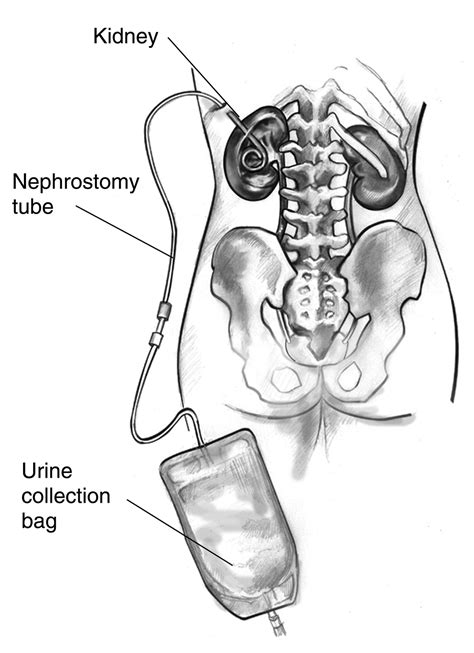 Nephrostomy | Copenhagen MedLab