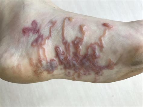 Risk Of Going Barefoot Hookworm Parasites Infect Canadian Couple