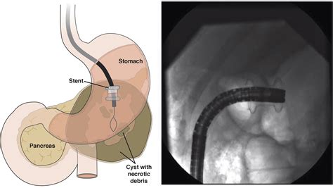 Endoscopic Drainage Of Pancreatic Fluid Collections Clinical