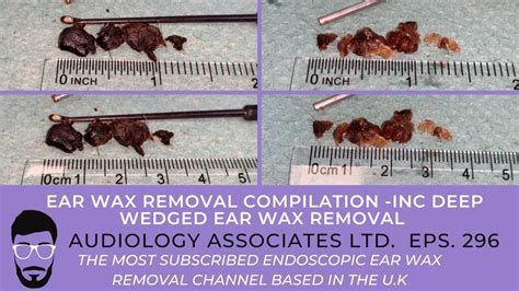 Ear Wax Removal Compilation Inc Deep Wedged Ear Wax Removal Ep 296