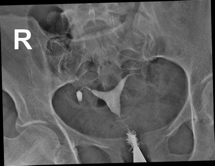 Right Tubal Isthmus Diverticulum Hysterosalpingogram Radiology Case