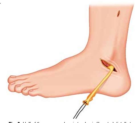 Figure 1 From Minimally Invasive Reconstruction Of Anterior Talofibular