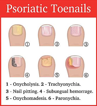 Psoriatic PNG Transparent Images Free Download | Vector Files | Pngtree