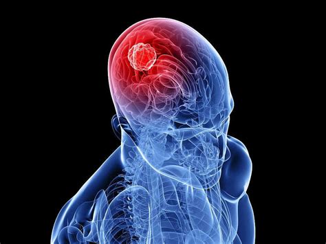 Brain Aneurysm 10 Causes Of A Brain Aneurysm