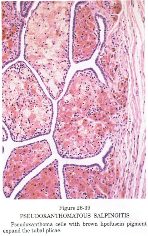 Chronic Inflammation: Chronic Ovary Inflammation