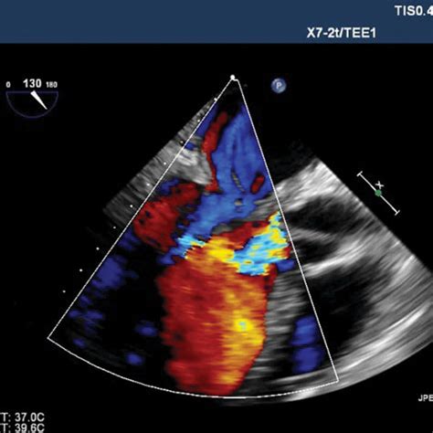 Transesophageal Echocardiography Color Doppler Showing No Residual