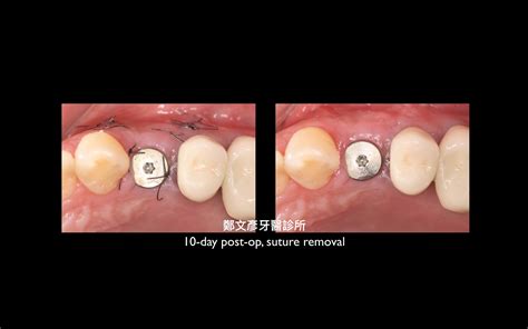 3 Role Of Granulation Tissue In Socket Preservation 鄭文彥牙醫診所的部落格 Udn部落格