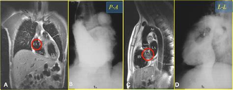 Chest X Ray Cardiac Anatomy And Pathology Correlation With