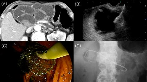 Figure 1 From Endoscopic Ultrasound Guided Gastrojejunostomy For