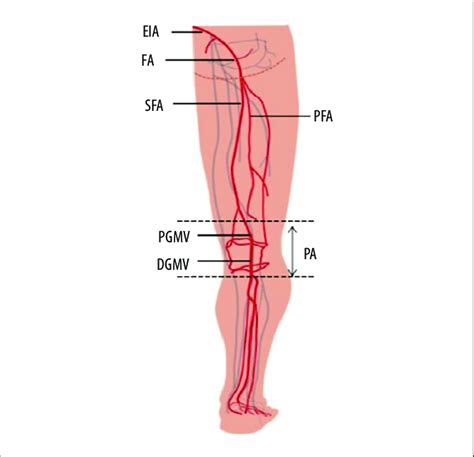 Schematic Illustration Of Vascular Injury Sites In Lower Extremity Eia Download Scientific